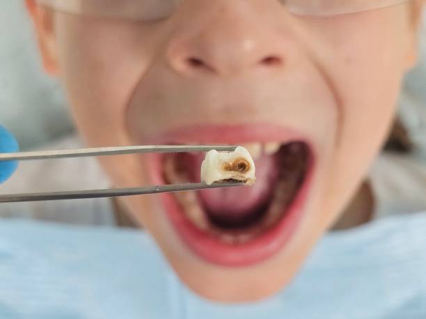 Best Emergency Tooth Extraction in Batesville, TX