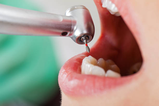 Best Emergency Tooth Extraction in Batesville, TX